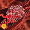 Thrombosis & Thromboembolism 2022 Thrombosis & Thromboembolism 2022