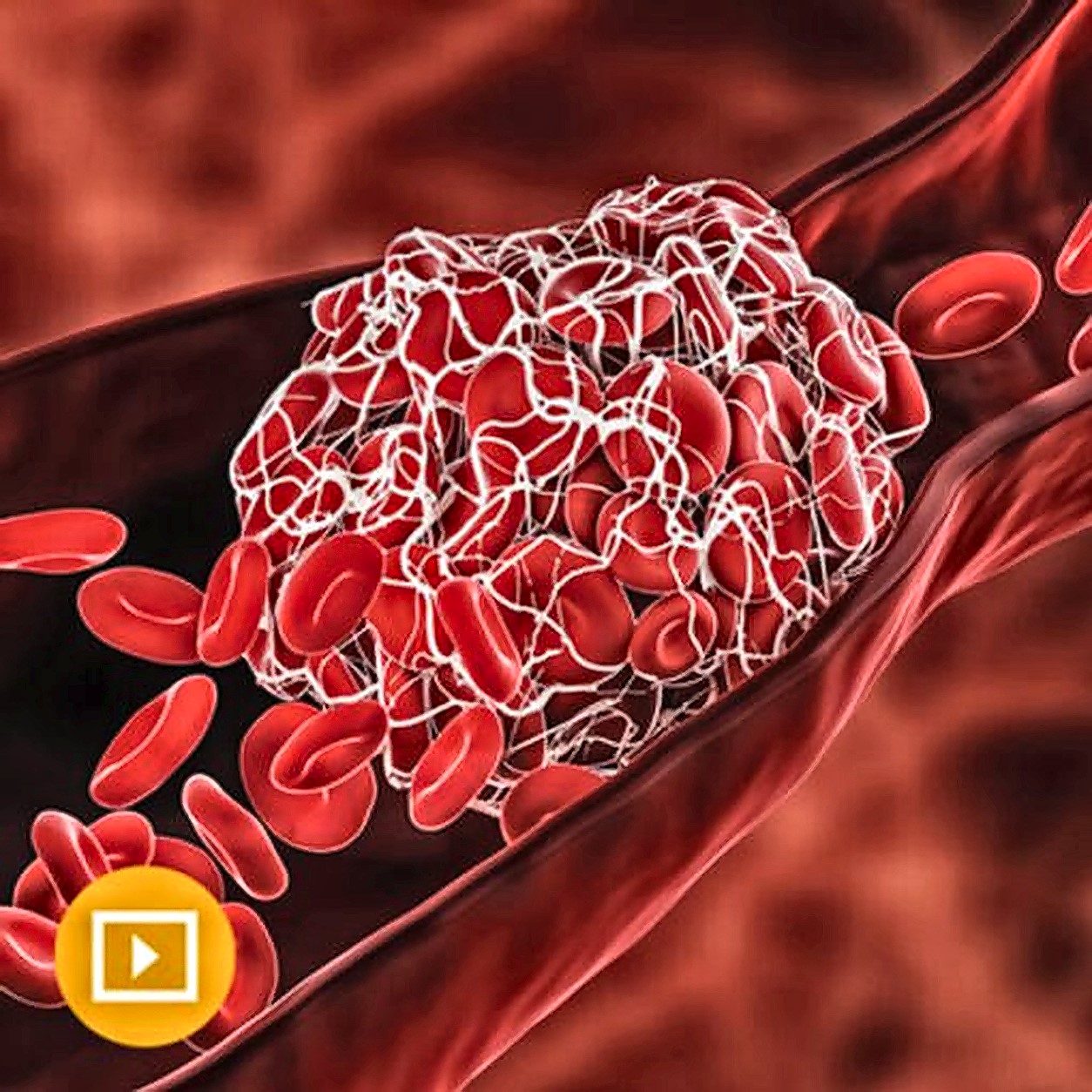Thrombosis & Thromboembolism 2022 Thrombosis & Thromboembolism 2022
