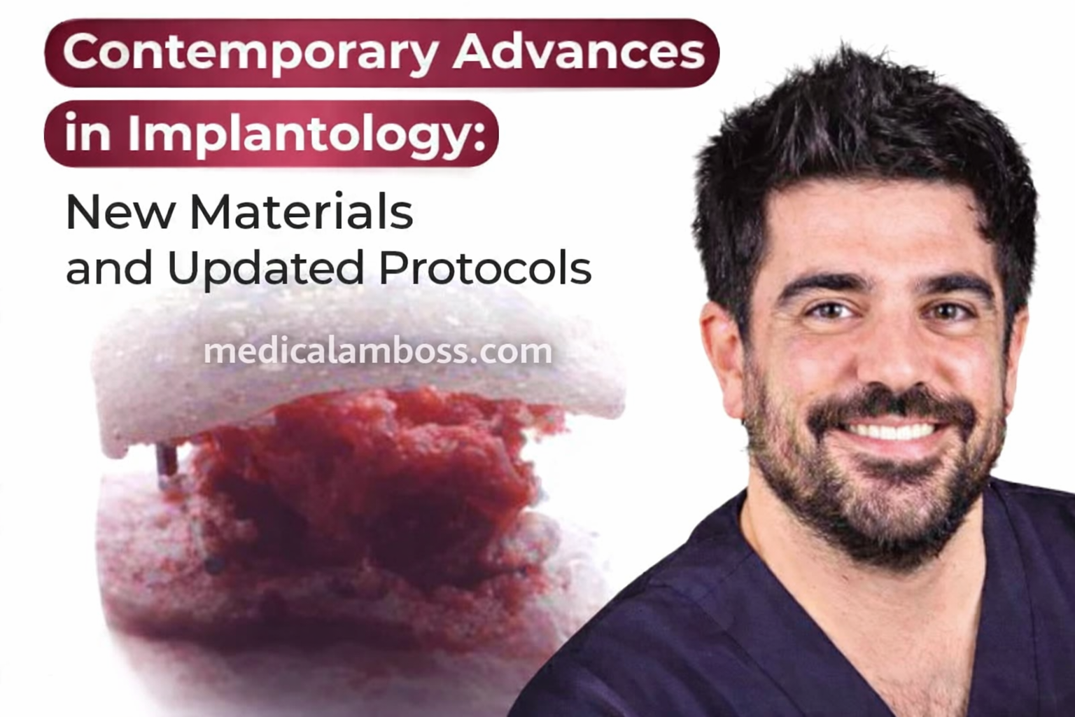 OHI-S Contemporary Advances in Implantology New Materials and Updated Protocols OHI-S Contemporary Advances in Implantology New Materials and Updated Protocols