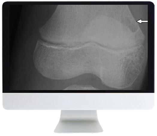 ARRS Clinical Case-Based Review of Musculoskeletal Imaging 2019 ARRS Clinical Case-Based Review of Musculoskeletal Imaging 2019