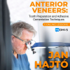 Anterior Veneer: Tooth Preparation and Adhesive Cementation Techniques Anterior Veneer: Tooth Preparation and Adhesive Cementation Techniques