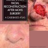 Combination Facial Reconstruction After Mohs Surgery: A Case Based Atlas (Original PDF From Publisher) Combination Facial Reconstruction After Mohs Surgery: A Case Based Atlas (Original PDF From Publisher)