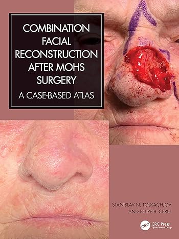 Combination Facial Reconstruction After Mohs Surgery: A Case Based Atlas (Original PDF From Publisher) Combination Facial Reconstruction After Mohs Surgery: A Case Based Atlas (Original PDF From Publisher)