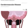 CONTINUUM Lifelong Learning in Neurology April 2023, Volume 29, Issue 2 (True PDF) CONTINUUM Lifelong Learning in Neurology April 2023 Volume 29 Issue 2 True PDF
