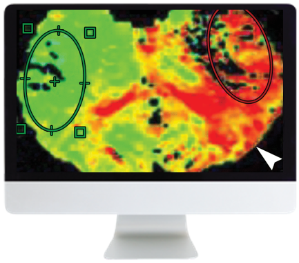 Code Stroke: What The Radiologist Needs To Know In The Changing Landscape Of Acute Ischemic Stroke 2019 (Videos) Code Stroke: What The Radiologist Needs To Know In The Changing Landscape Of Acute Ischemic Stroke 2019 (Videos)