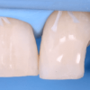 Gidedental Direct and Indirect Adhesive Restorations Gidedental Direct and Indirect Adhesive Restorations