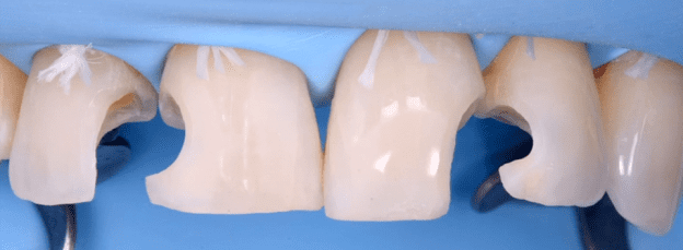 Gidedental Direct and Indirect Adhesive Restorations Gidedental Direct and Indirect Adhesive Restorations