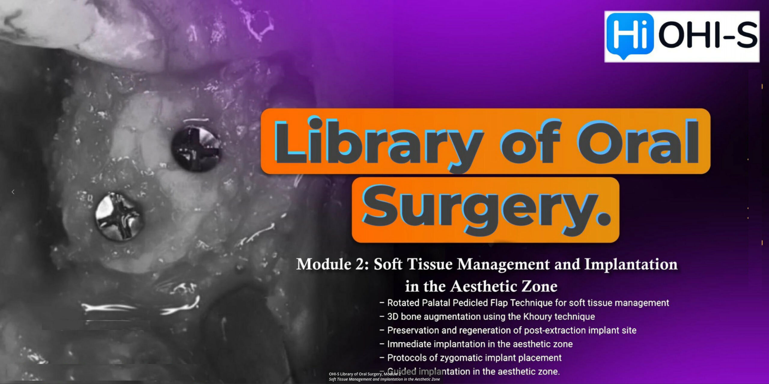 Library of Oral Surgery. Module 2: Soft Tissue Management and Implantation in the Aesthetic Zone Library of Oral Surgery. Module 2: Soft Tissue Management and Implantation in the Aesthetic Zone