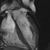 MRIOnline Mastery Series Cardiac MRI of Non Ischemic Cardiomyopathy 2021 CME VIDEOS