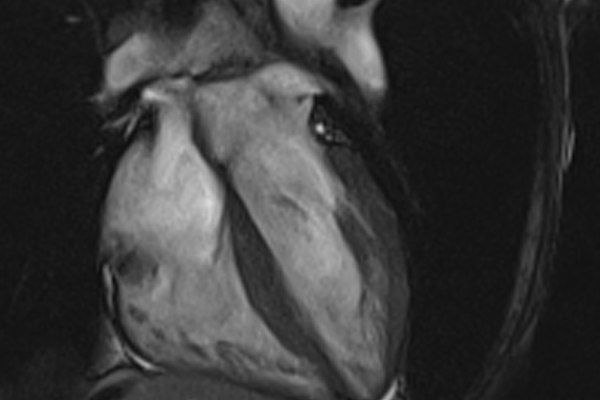 MRIOnline Mastery Series: Cardiac MRI of Non-Ischemic Cardiomyopathy 2021 MRIOnline Mastery Series Cardiac MRI of Non Ischemic Cardiomyopathy 2021 CME VIDEOS