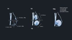 MRIOnline Mastery Series Evaluation of Newly Diagnosed Pre Operative Breast Cancer Patients 2021 CME VIDEOS