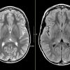 MRIOnline Mastery Series: Neurofibromatosis Type 1 (NF1) 2021 VIDEOS) MRIOnline Mastery Series Neurofibromatosis Type 1 NF1 2021