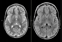 MRIOnline Mastery Series Neurofibromatosis Type 1 NF1 2021