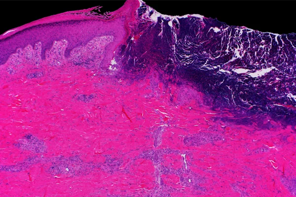 Mayo Clinic Wound Symposium: The Edges Of Wound Care 2023 (Videos+Assessment Quiz) Mayo Clinic Wound Symposium