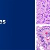 Memorial Sloan Kettering Cancer Center The Pathology of Neoplastic Diseases 2023 Memorial Sloan Kettering Cancer Center The Pathology of Neoplastic Diseases 2023