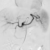 NYU Langone Vascular and Interventional Radiology Review and Update 2023 NYU Langone Vascular and Interventional Radiology Review and Update 2023