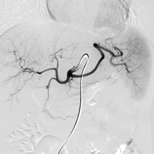 NYU Langone Vascular and Interventional Radiology Review and Update 2023 NYU Langone Vascular and Interventional Radiology Review and Update 2023