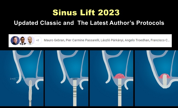 OHI-S Sinus Lift 2023: Updated Classic and the Latest Author’s Protocols OHI S Sinus Lift 2023 Updated Classic and the Latest Authors Protocols