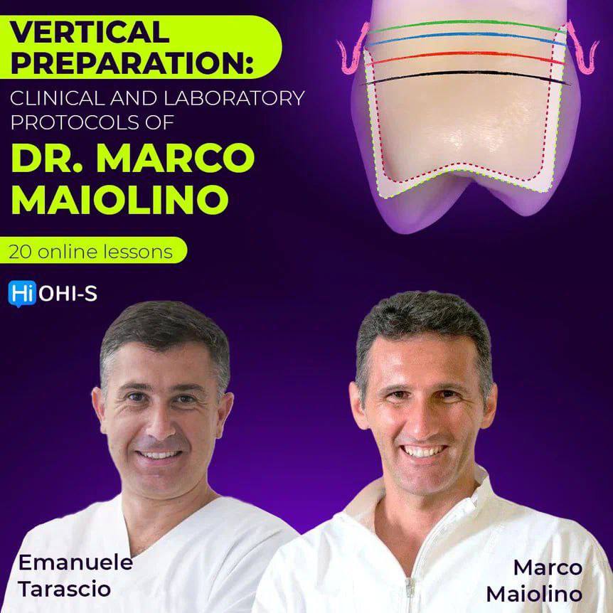 OHI-S Vertical Preparation: Team Approach, Clinic+Dental Lab – Marco Maiolino, Emanuele Tarascio OHI-S Vertical Preparation: Team Approach, Clinic+Dental Lab – Marco Maiolino, Emanuele Tarascio