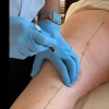 Lyftogt Perineural Injection Treatment videos: Knee collection Lyftogt Perineural Injection Treatment videos: Knee collection