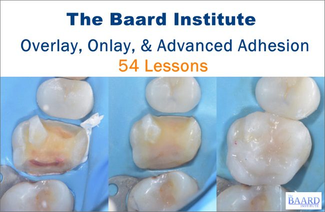 The Baard Institute Overlay, Onlay, & Advanced Adhesion The Baard Institute Overlay, Onlay, & Advanced Adhesion
