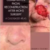 combination facial reconstruction after mohs surgery a case based atlas pdf book 1