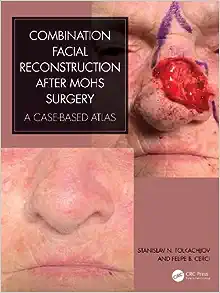 combination facial reconstruction after mohs surgery a case based atlas pdf book 1