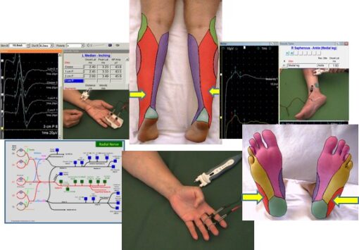 EMG/NCS Online Series: Volume III Sensory Nerve Conduction Studies (2nd Edition) (Videos) emg ncs online series volume iii afkebooks 510x355 1