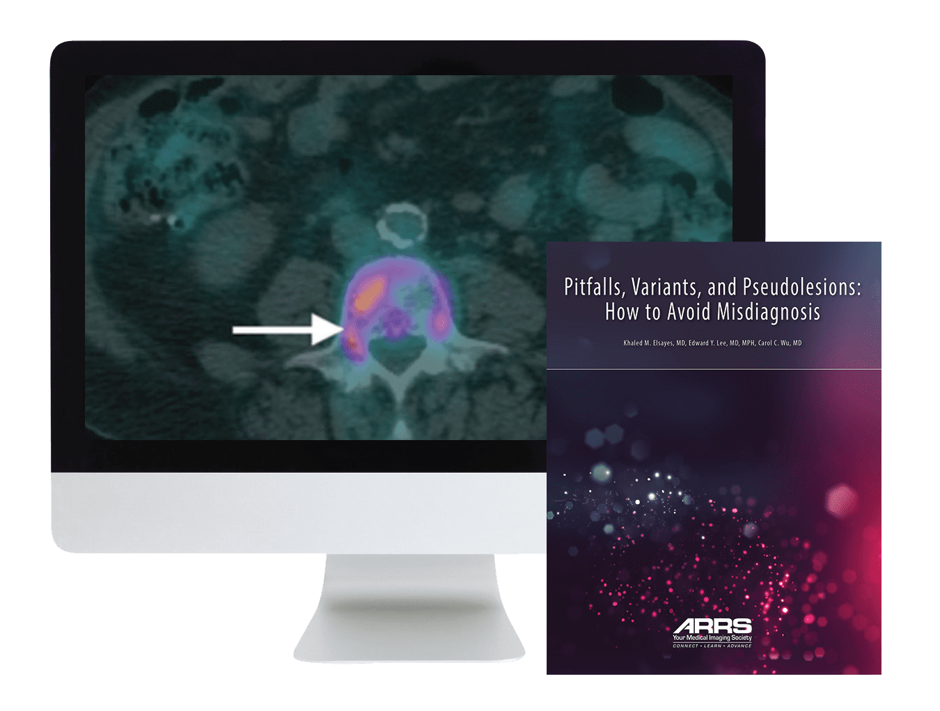 ARRS Pitfalls, Variants, and Pseudolesions: How to Avoid Misdiagnosis 2019 new pitfalls variants