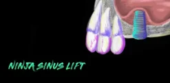 ninja sinus lift 510x250 1