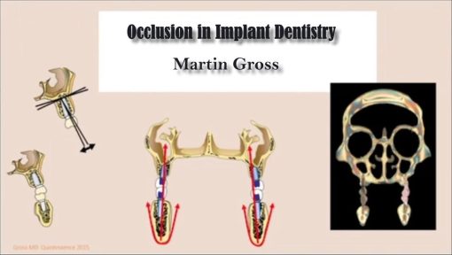 Occlusion in Implant Dentistry – Martin Gross (Course) Occlusion in Implant Dentistry