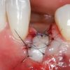 Gidedental Soft Tissue Management around Natural Teeth and Dental Implants 2020 soft tissue2 1 624x351 1 510x287 1