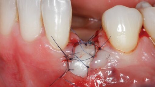 Gidedental Soft Tissue Management around Natural Teeth and Dental Implants 2020 soft tissue2 1 624x351 1 510x287 1