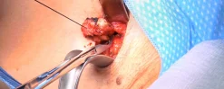 surgical Video Articles   JOMI Video Journal   Peer Reviewed1 2023