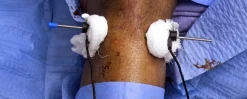 surgical Video Articles   JOMI Video Journal   Peer Reviewed2 2023