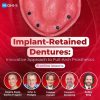 OHI-S Implant-Retained Dentures: Innovative Approach to Full-Arch Prosthetics OHI-S Implant-Retained Dentures: Innovative Approach to Full-Arch Prosthetics
