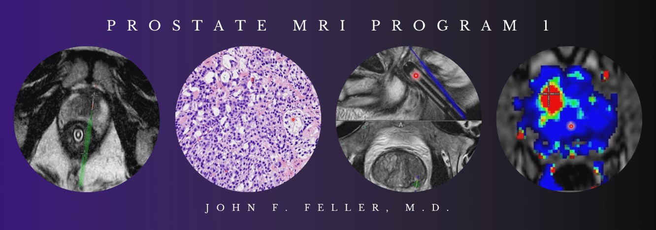 2021 Prostate MRI (Program 1) – John F. Feller, M.D(vedio) 2021 Prostate MRI (Program 1) – John F. Feller, M.D