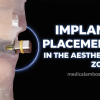 Implant placement in the aesthetic zone steps and techniques OHI-S Implant placement in the aesthetic zone steps and techniques