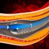 Comprehensive Review and Update of What’s New in Vascular and Endovascular Surgery Comprehensive Review and Update of What’s New in Vascular and Endovascular Surgery