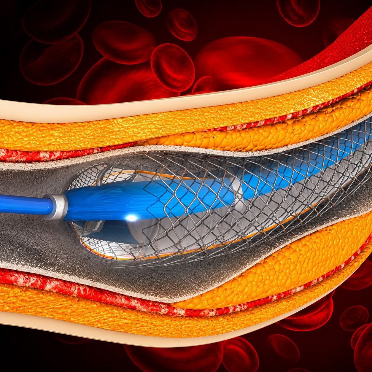 Comprehensive Review and Update of What’s New in Vascular and Endovascular Surgery Comprehensive Review and Update of What’s New in Vascular and Endovascular Surgery