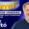 OHI-S Anterior Veneers Smile Design and Treatment Planning by Jan Hajtó OHI-S Anterior Veneers Smile Design and Treatment Planning by Jan Hajtó
