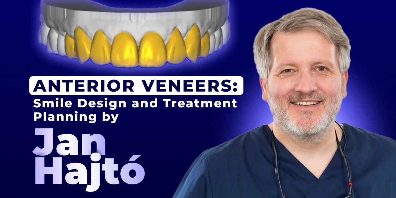 OHI-S Anterior Veneers Smile Design and Treatment Planning by Jan Hajtó OHI-S Anterior Veneers Smile Design and Treatment Planning by Jan Hajtó