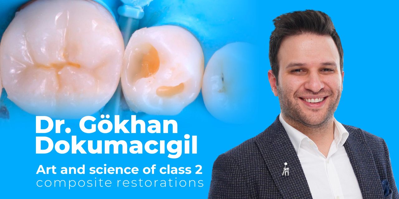 OHI-S Art and science of class 2 composite restorations OHI-S Art and science of class 2 composite restorations