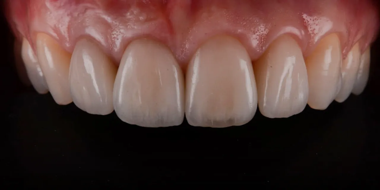 OHI-S Ceramic Veneers Interdisciplinary Approach and Updated Protocols OHI-S Ceramic Veneers Interdisciplinary Approach and Updated Protocols