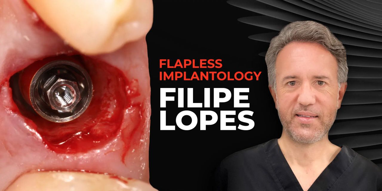 OHI-S Flapless implantology protocols for immediate implant placement and loading OHI-S Flapless implantology protocols for immediate implant placement and loading