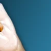 OHI-S Root perforations – diagnosis and treatment