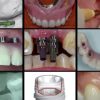 Gidedental A-Z in Restorative Implant Dentistry Gidedental A-Z in Restorative Implant Dentistry