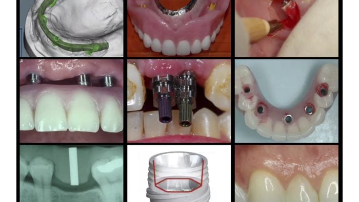 Gidedental A-Z in Restorative Implant Dentistry Gidedental A-Z in Restorative Implant Dentistry