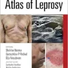 Atlas of Leprosy (Original PDF from Publisher+Videos) Atlas of Leprosy (Original PDF from Publisher+Videos)