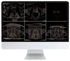 ARRS Pearls and Pitfalls in Prostate and Pelvic Imaging 2021